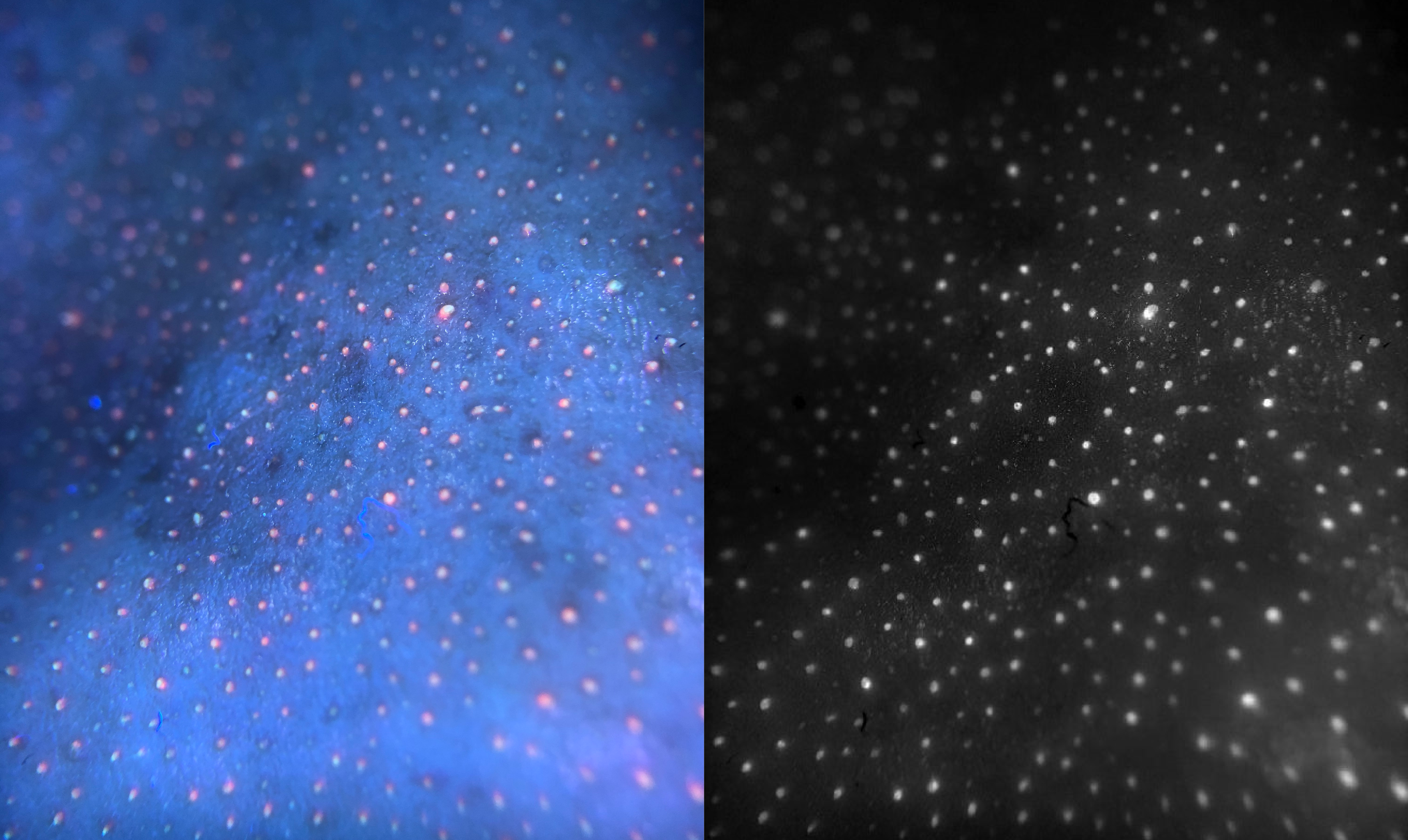 Справа - изображение RGB-автофлуоресценции кожи лица добровольца. Слева - псевдомультиспектральное изображение той же области, с удалением загрязнений от фоновых сигналов. Белые области на псевдомультиспектральном изображении указывают на высокий уровень порфиринов.