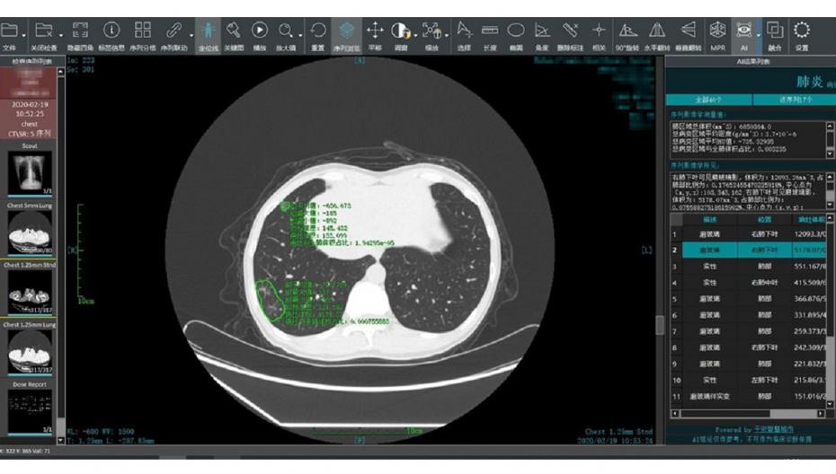 Система расшифровки КТ-сканов компании Ping An ускоряет диагностику и лечение COVID-19