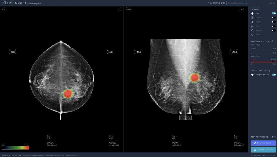 Система диагностики рака груди Lunit разрешена к использованию в Европе