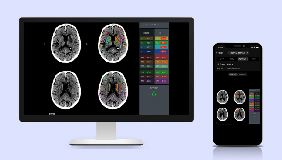 Rapid ASPECTS: система визуального анализа помогает диагностировать повреждения мозга