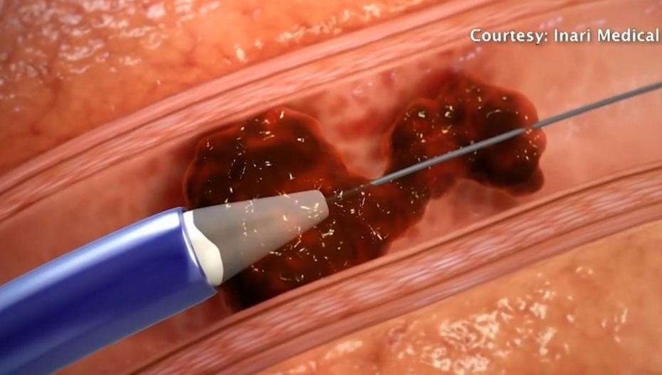 Устройство для быстрого удаления тромбов из легочных артерий 