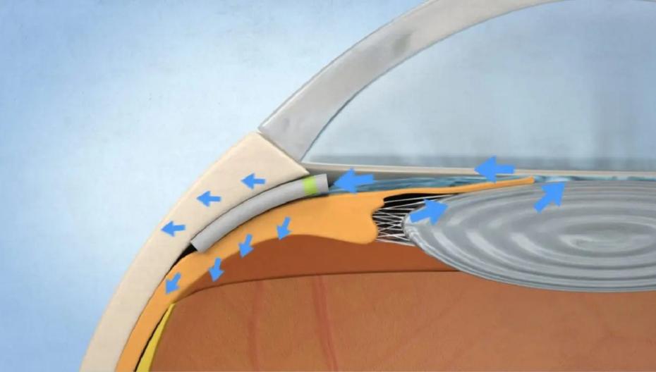 iStar выводит на рынок Европы свой имплантат для лечения глаукомы