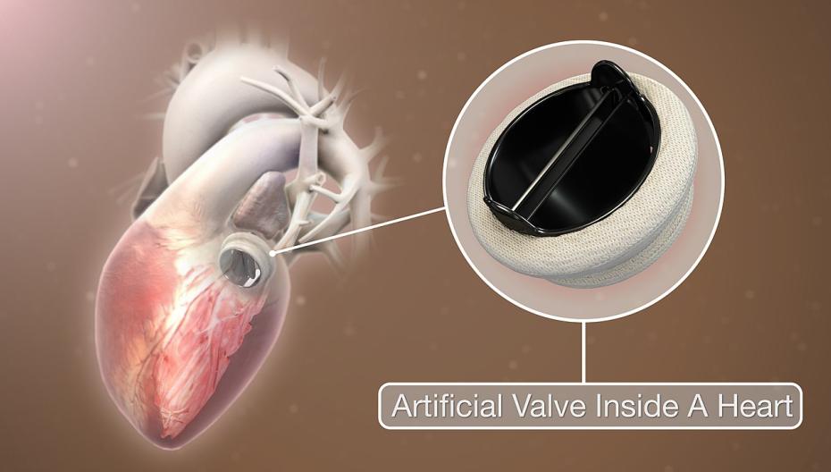 Изготовленные на 3D-принтере регенеративные сердечные клапаны, которые растут вместе с пациентами