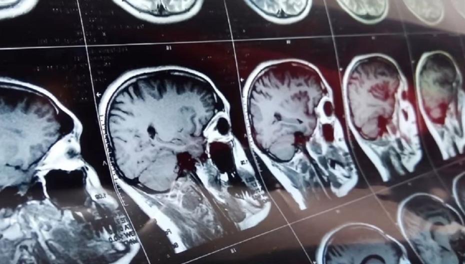 Искусственный интеллект как инструмент выявления инсульта еще не способен заменить врачей