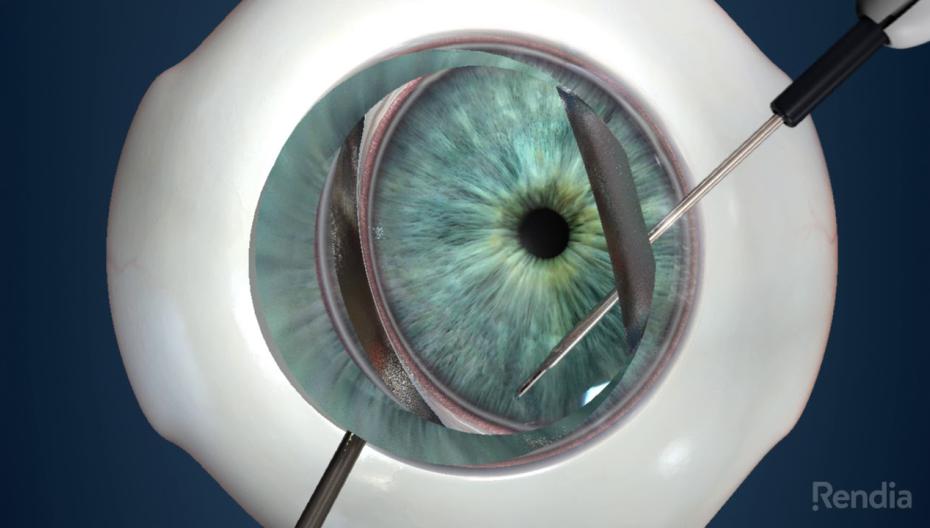 Компания Glaukos выводит на рынок новейший глазной стент для снижения давления при глаукоме