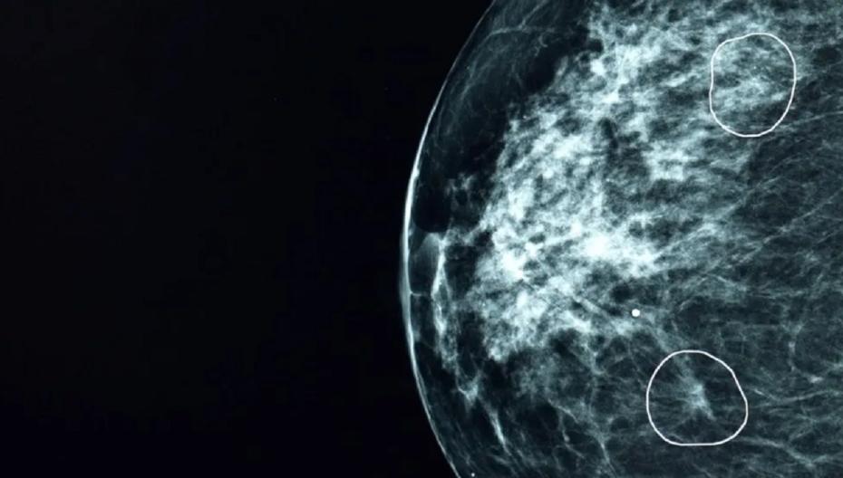 ИИ-тест выявляет крошечные раковые опухоли, пропущенные врачами