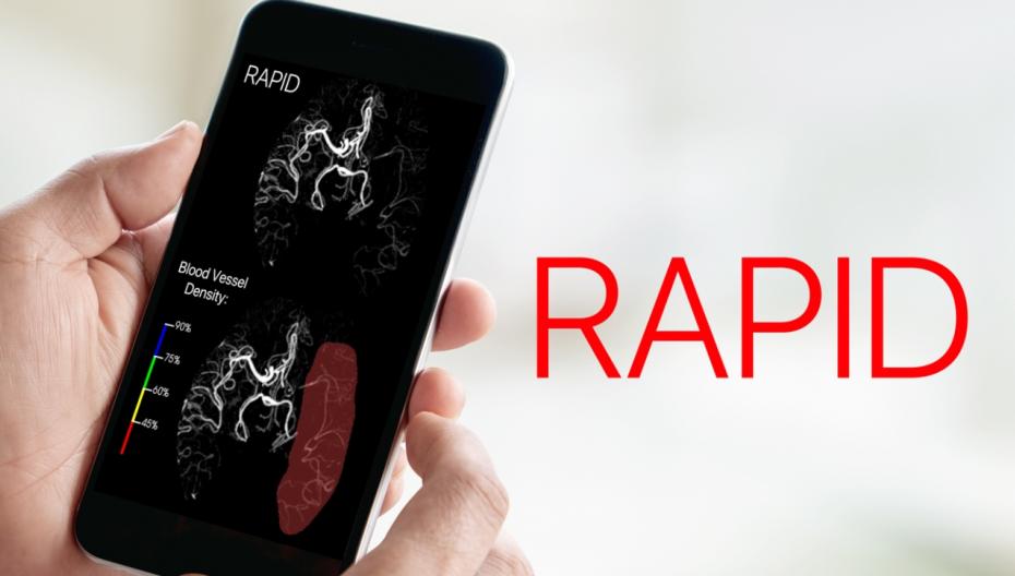 AI-платформа RAPID допущена для определения пациентов, которым показана эндоваскулярная тромбэктомия