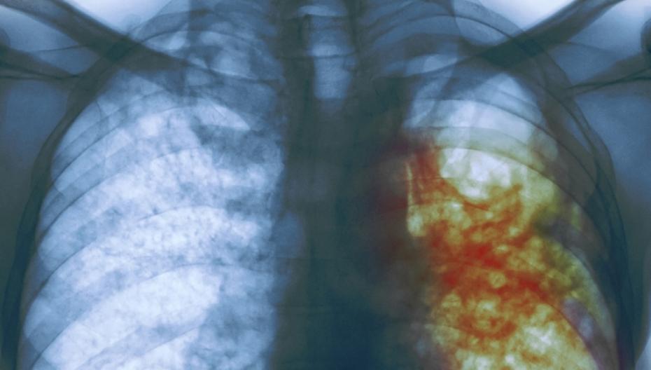 Точность диагностики туберкулеза искусственным интеллектом близка к 100%