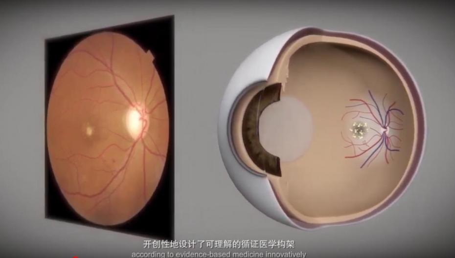 Китайские больницы использует AI-системы для обнаружения глазных заболеваний