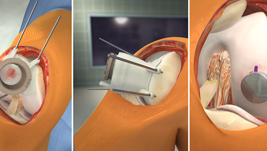 Симулятор для хирургии коленного сустава от Touch Surgery и Episurf Medical 