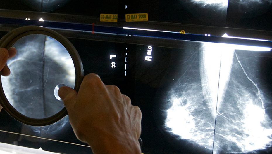Компьютер анализирует маммограммы с 99%-точностью