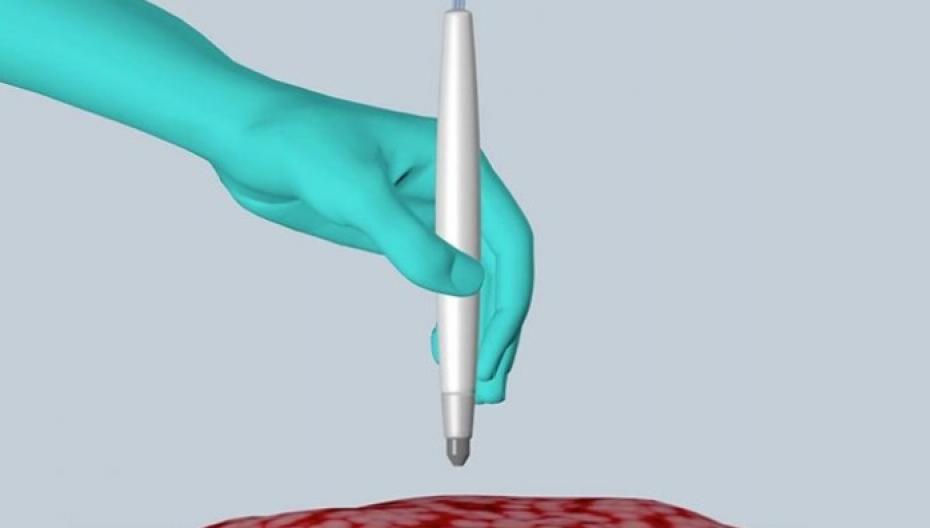 Хирургическая ручка способна идентифицировать рак в реальном времени