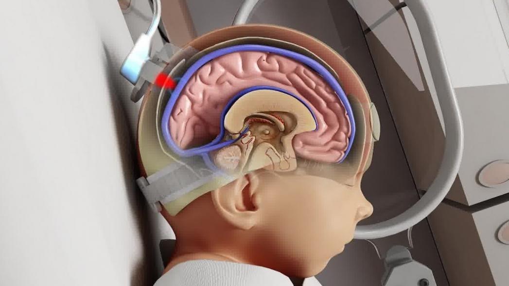 Технология, которая должна спасти младенцев от церебрального паралича