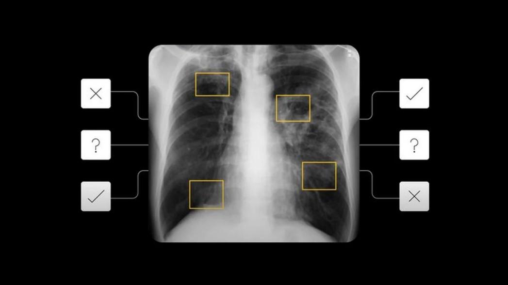 Google создает AI-систему для диагностики туберкулеза