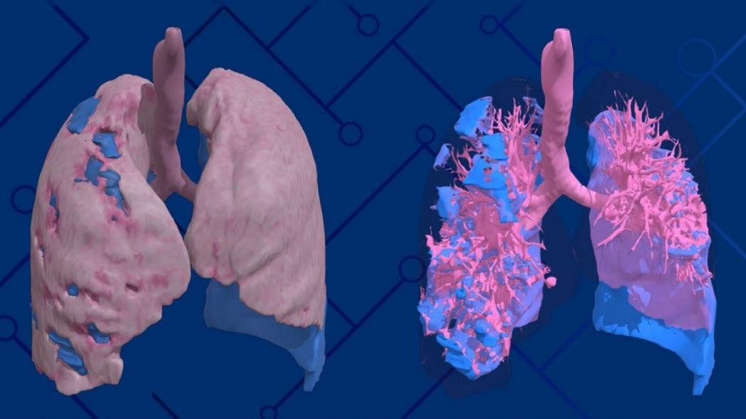 3D-модель легких показывает, как КОВИД-19 повреждает этот орган