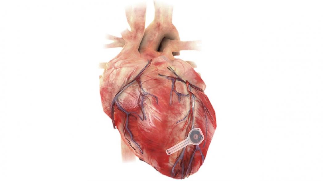 Беспроводной кардиостимулятор, который растворяется в теле, когда перестает быть нужным