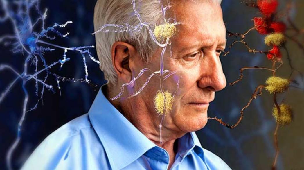 Сканирование мозга поможет определить, когда у вас проявятся симптомы деменции