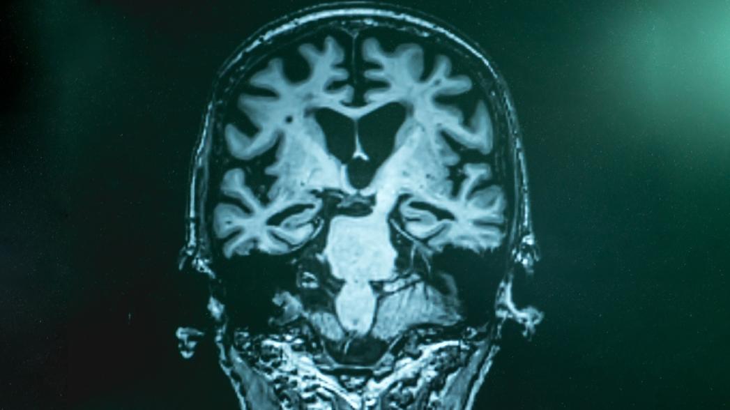 Активность мозга во сне и при анестезии - ключ к разгадке болезни Альцгеймера