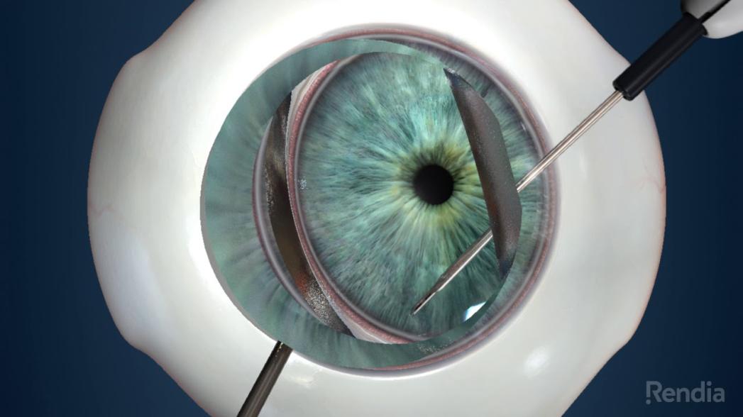 Компания Glaukos выводит на рынок новейший глазной стент для снижения давления при глаукоме
