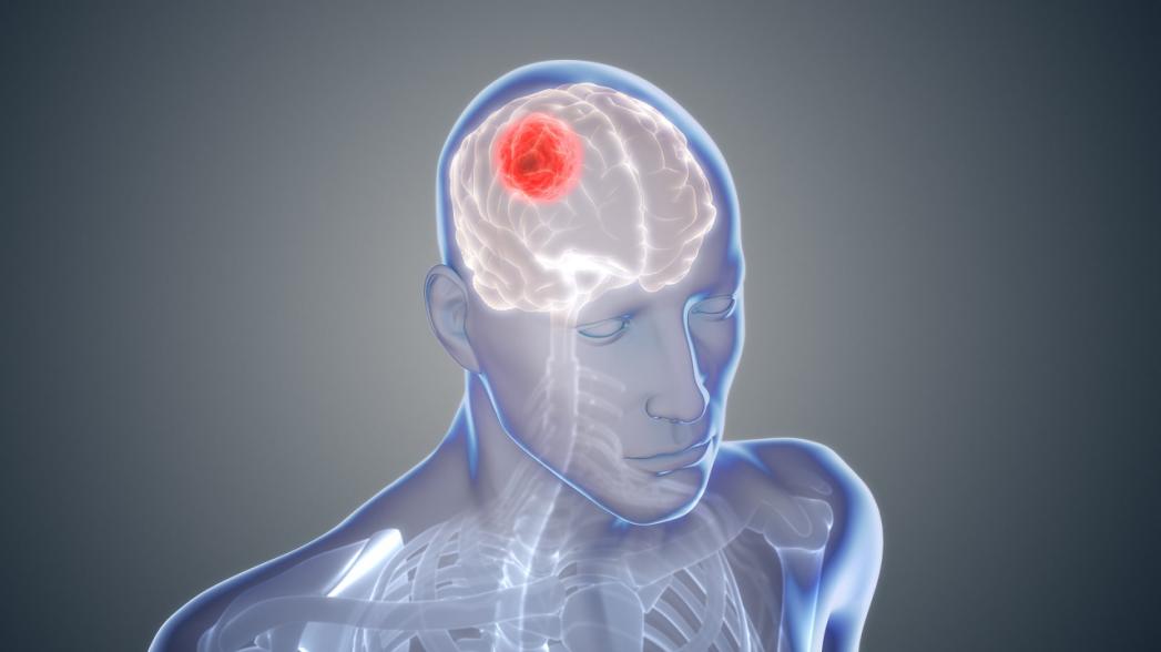 Выявление злокачественных опухолей мозга может быть улучшено на треть