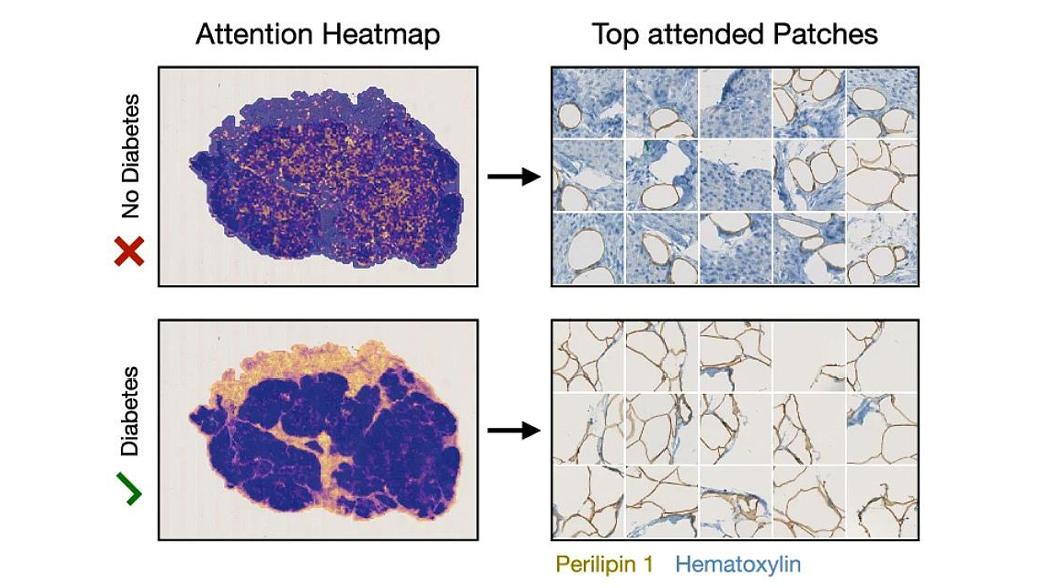 ИИ «увидел» то, что не видит микроскоп при СД2