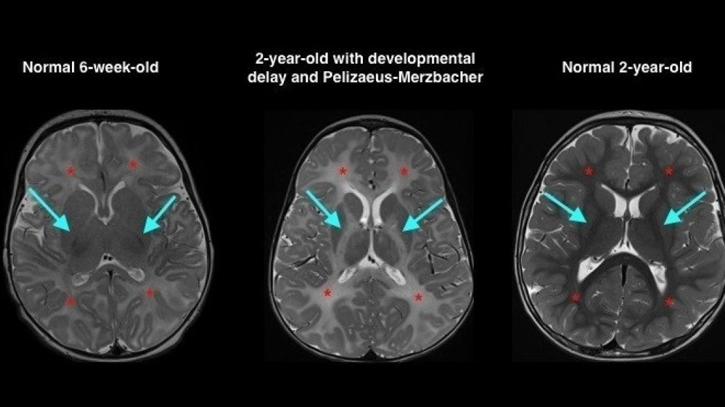 Система машинного обучения для расшифровки сканов мозга в педиатрии от GE
