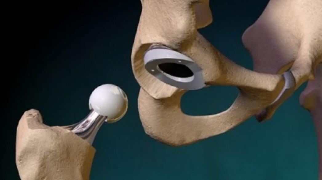 Первый тазобедренный протез, созданный с помощью 3-D технологий