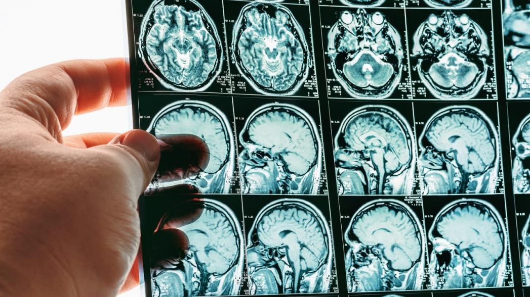 AI-система обнаружения кровоизлияний в мозге получила разрешение к применению в США
