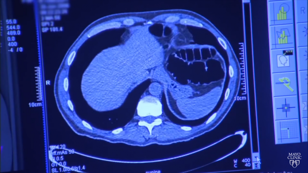 AI-система Google превзошла 6 радиологов в диагностике рака легких