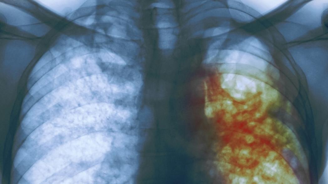 Точность диагностики туберкулеза искусственным интеллектом близка к 100%