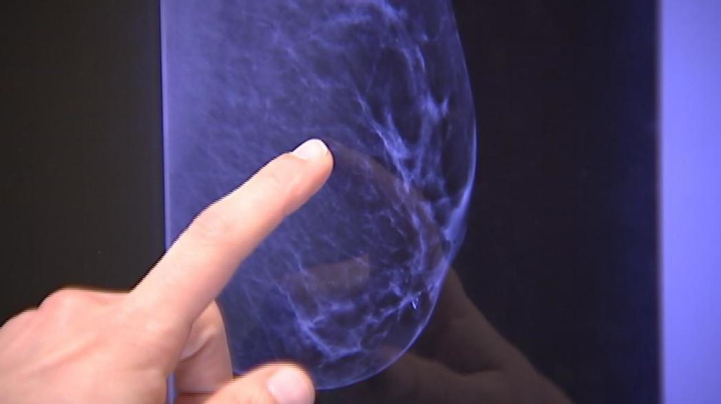 Решение МТИ на базе AI может предсказать рак груди за 5 лет до заболевания