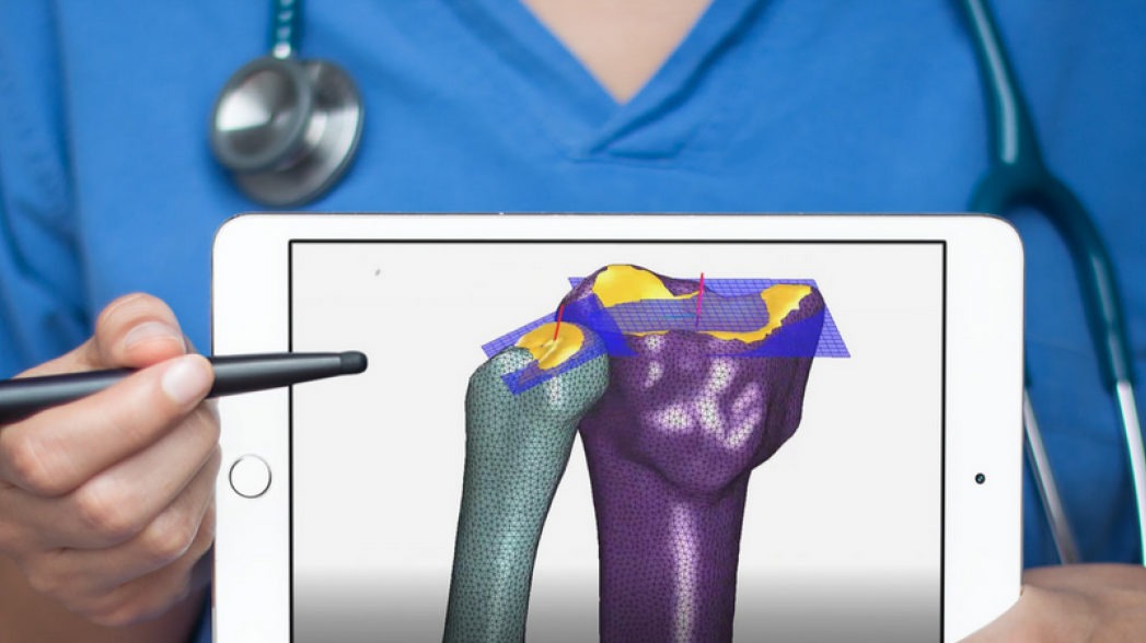 Система поддержки решений для ортопедии помогает при анализе и лечении переломов