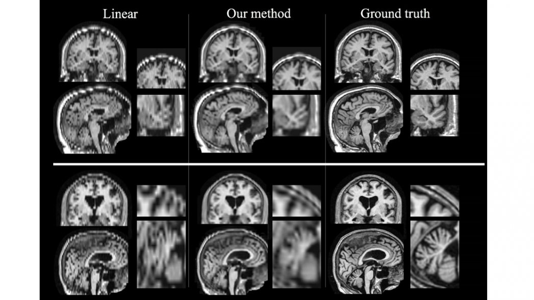 Искусственный интеллект улучшает проведение МРТ для пострадавших от инсульта 