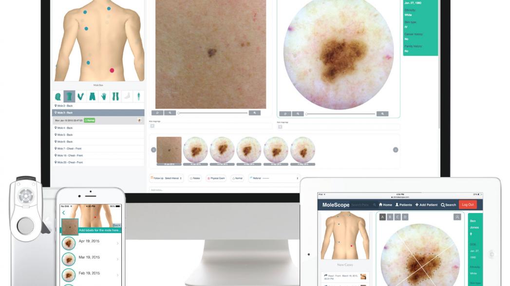 MoleScope: приложение для диагностики рака кожи