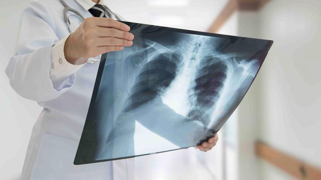 AI-система сокращает время анализа рентгеновских снимков грудной клетки
